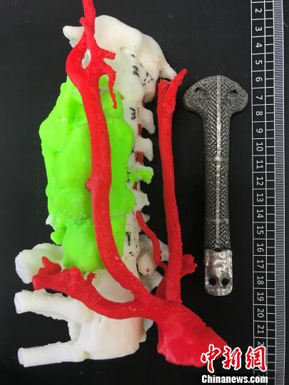 上海医学专家率先3D打印全颈椎助患者颈椎“再生”